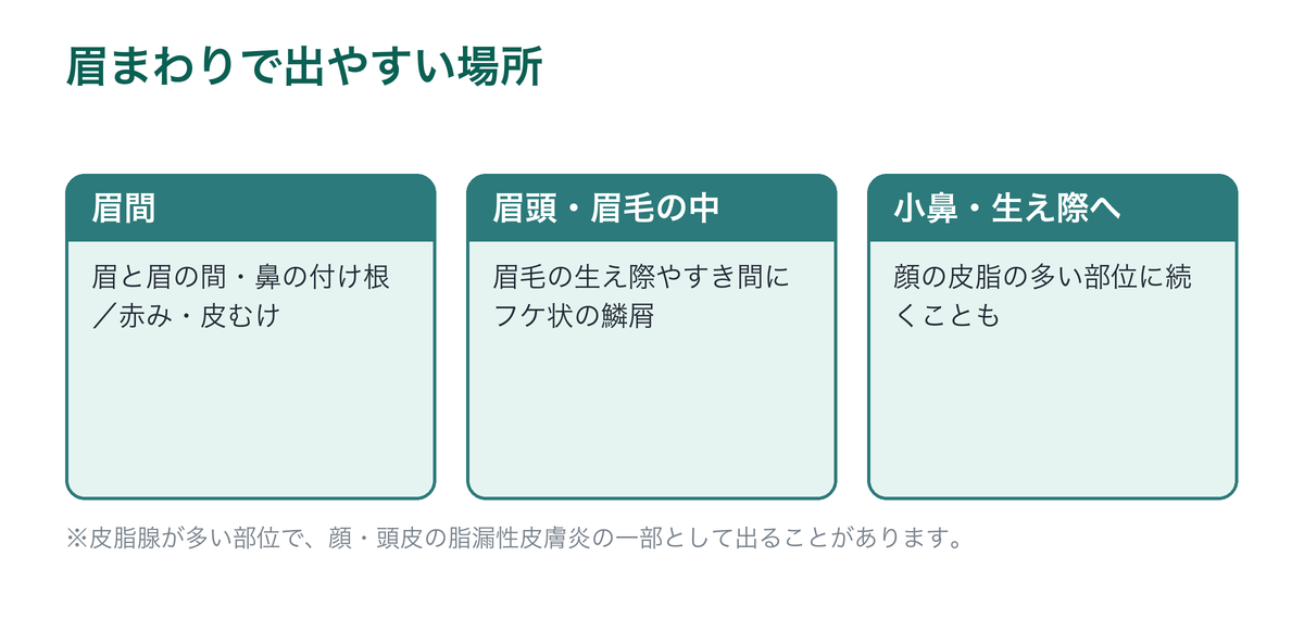 眉毛・眉間で脂漏性皮膚炎が出やすい場所を示した図