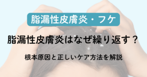 脂漏性皮膚炎はなぜ繰り返す？根本原因と正しいケア方法を解説のアイキャッチ画像
